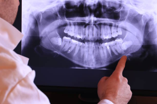 Best Emergency Wisdom Teeth Removal in Somerville, TN